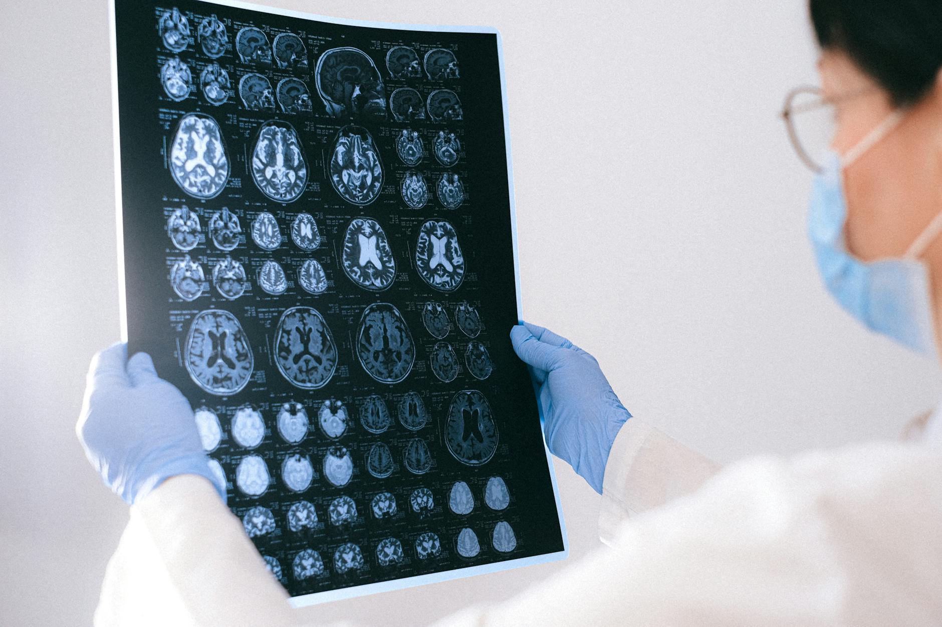 Un médico sosteniendo el resultado de una resonancia magnética del cerebro