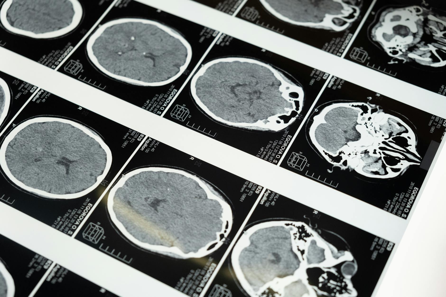 Images IRM du cerveau